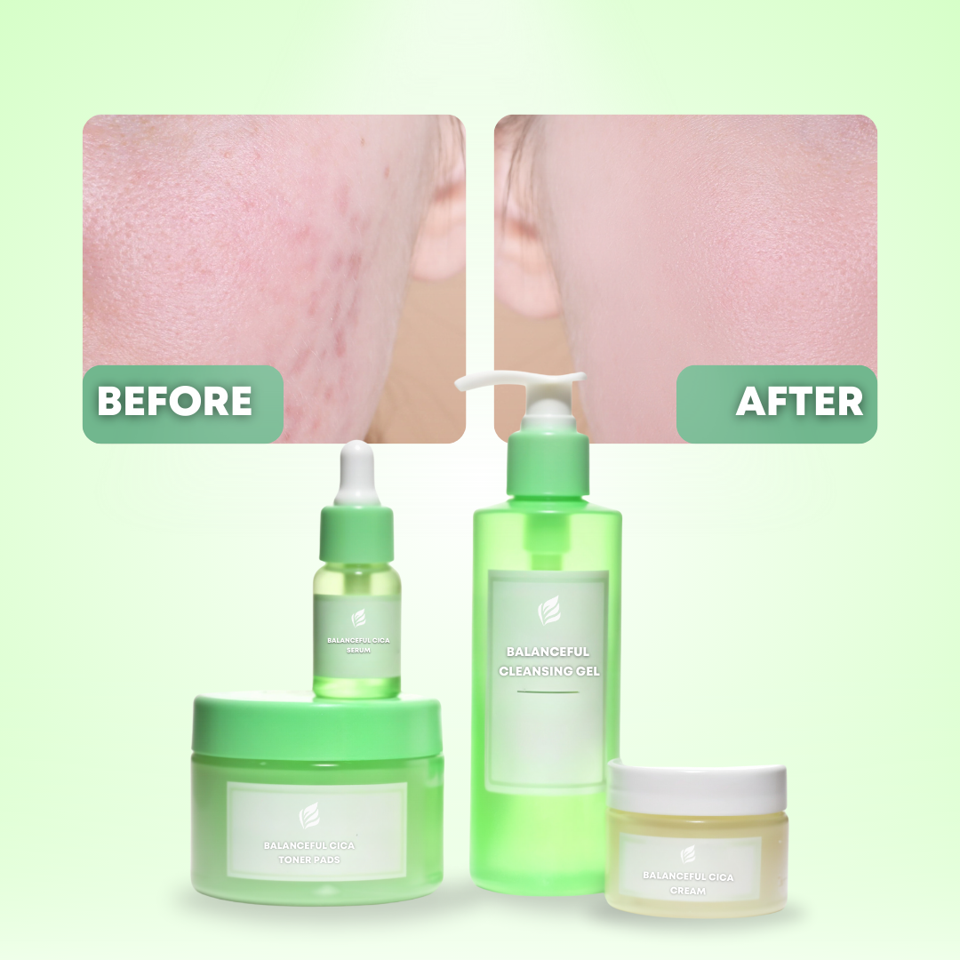 Acne Treatment with Cica Skin Care Set