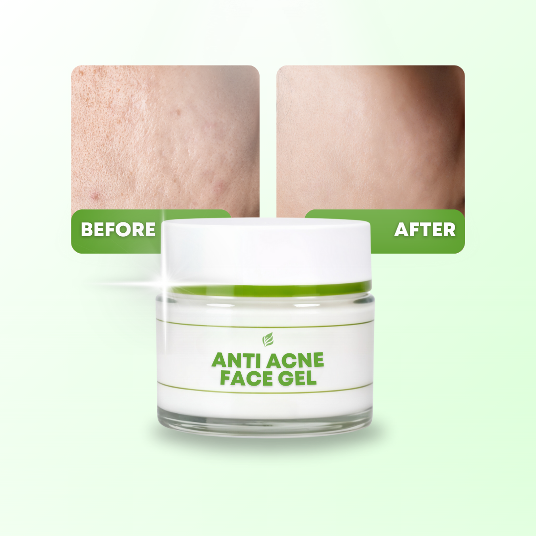 Anti Acne Cream For Men and Women